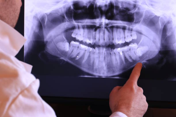 Best Knocked-Out Tooth (Avulsed Tooth) Treatment in Pulaski, VA